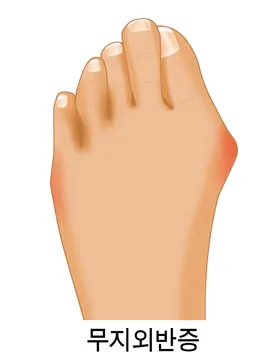 무지외반증 모식도. 엄지발가락이 둘째 발가락 쪽으로 휘고 발 안쪽 발허리뼈 머리가 튀어나온 모습.